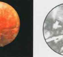 Histeroskopija kot metoda za vizualno oceno površino rane maternice po dostavi