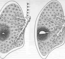 Pljučni absces: simptomi, zdravljenje, diagnoza, zapletov, vzroki, simptomi