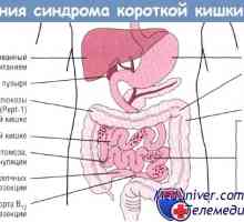 Preprečevanje in napoved sindrom kratkega črevesa (SPO)