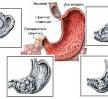 Adenokarcinom (rak), želodcu