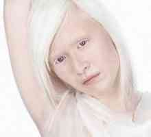 Albinizem pri ljudeh, oči