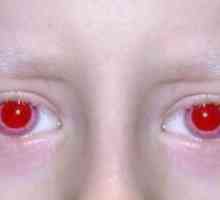 Albinizem pri ljudeh: simptomi, vzroki, simptomi, zdravljenje