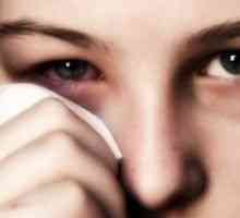 Alergijski konjunktivitis: zdravljenje, simptomi, vzroki, simptomi