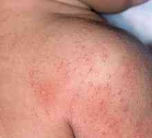 Alergija dysbacteriosis