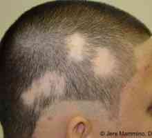 Alopecia areata: Zdravljenje