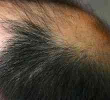 Alopecija las: Zdravljenje, vzroki, simptomi, znaki
