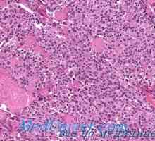 Rak ščitnice amiloida. Scirrhous raka ščitnice