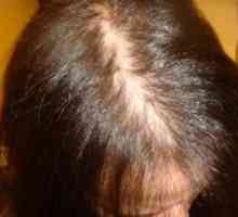 Androgenetic alopecija pri ženskah, pri moških: simptomi, zdravljenje