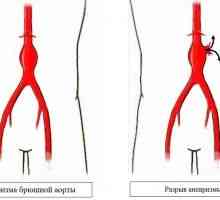 Abdominalne aorte anevrizma (trebuhu oddelek): simptomi, zdravljenje, diagnozo, vzroki, simptomi