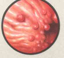 Antralnih gastritis hiperplastični