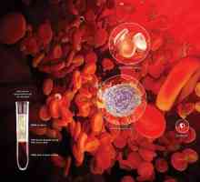 Aplastične anemije: zdravljenje, simptomi, vzroki, diagnoza