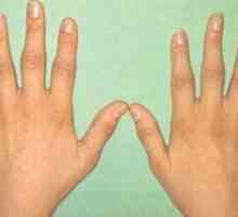Artritis metakarpalnem falango skupno roke: zdravljenje, simptomi, znaki, vzroki