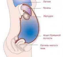 Ascites, peritonitis