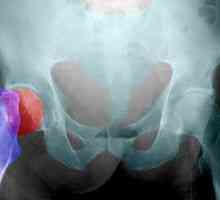 Aseptično nekrozo kosti: fazi zdravljenja, vzroki, simptomi, znaki