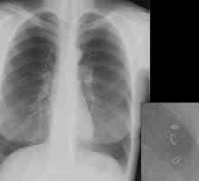 Ascaris v pljučih, grlu, nosu, respiratornega trakta pri ljudeh