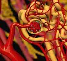 Ateroemboliya ledvične arterije