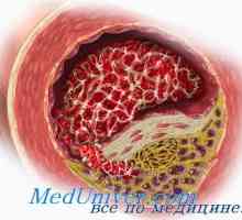 Ateroskleroza v menopavzi in menopavzi. Vpliv testosterona na arterioskleroze androgeni
