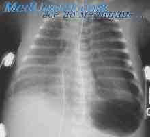Barotravma pljuč med dekompresijo. Patogeneza barotravma pljuč