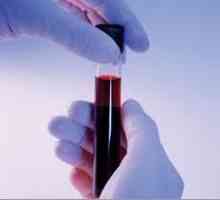 Biokemijska analiza krvi za pankreatitis
