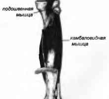 Bolečine v hrbtu, ki ga mišice soleus povzroča