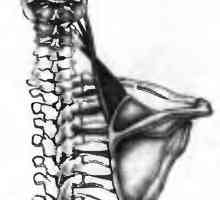 Bolečine v hrbtu, ki ga mišice mišico dvigalko lopatice povzroča