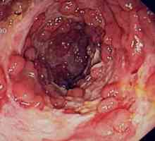 Crohnova bolezen, rak kolona, ​​simptomi in zdravljenje