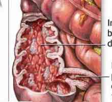 Bolezen tankega črevesja Crohnova