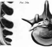 Bolečine v hrbtu hernija jedro pulposus (hernija diska)