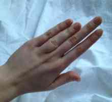 Brachydactyly palec: vzroki, zdravljenje, simptomi, znaki