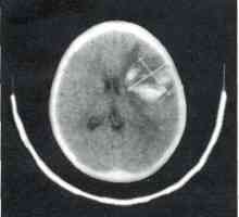 Travmatska poškodba možganov pri otrocih. Brain Poškodbe