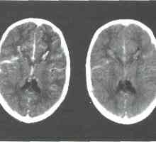 Travmatska poškodba možganov pri otrocih. intrakranialna krvavitev
