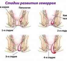 Štiri faza (obseg) hemoroide