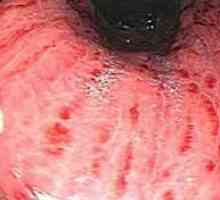 Kaj je površno gastroduodenitis: simptomi, vzroki in zdravljenje