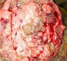 Možganska cisticerkoza