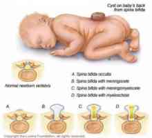 Nevralne cevi pri otrocih: encefalokela, meningomyelocoele