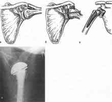 Deformiranja artroze sklepov zgornjega kraka