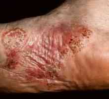 Dermatitis v rokah in nogah