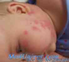 Diagnoza alergije in drugih stranskih učinkov zdravil pri otrocih