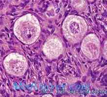 Disgerminoma seminom ali jajčnikov. Lipoidnokletochnye virilizing ovarijski tumorji