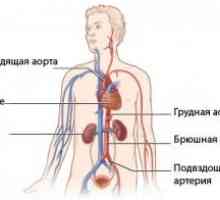 Aortna disekcija: klasifikacija, vzroki, simptomi, zdravljenje, kaj je to?