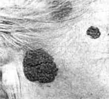 Benigni tumorjev kože, glave in vratu: pigmentirane nevus
