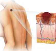 Benigni tumorji kože: vrste, klasifikacija, zdravljenje, simptomi