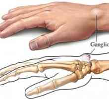 Benigni tumorji mehkih tkiv roke: zdravljenje, vzroki, simptomi, znaki