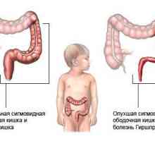 Dolichosigma črevesa pri otrocih