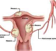 Endometrioza, zdravljenje, simptomi, znaki, vzroki