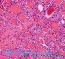 Folikularni velikocelični rak adenokarcinom in alveolarni ščitnice