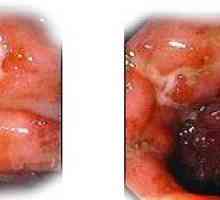 Oblike in faze Crohnovo boleznijo
