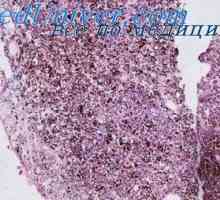 Ganglioneuroma in ganglionevroblastoma otroci. Feokromocitoma in teratom pri otrocih