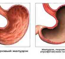 Gastritis in rak želodca