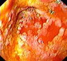 Gastritis z intestinalno metaplazijo